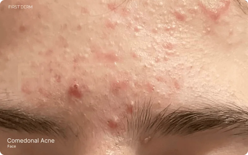 comedonal acne on the face, with visible inflammation, red slightly raised spots (papules), and pus-filled lesions (pustules)