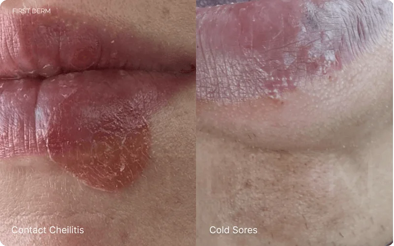 Split image showing Contact Cheilitis on the left, characterized by red, scaly patches on the lip, versus Cold Sores on the right, displaying grouped vesicles on an inflamed base, for a side-by-side comparison of these conditions