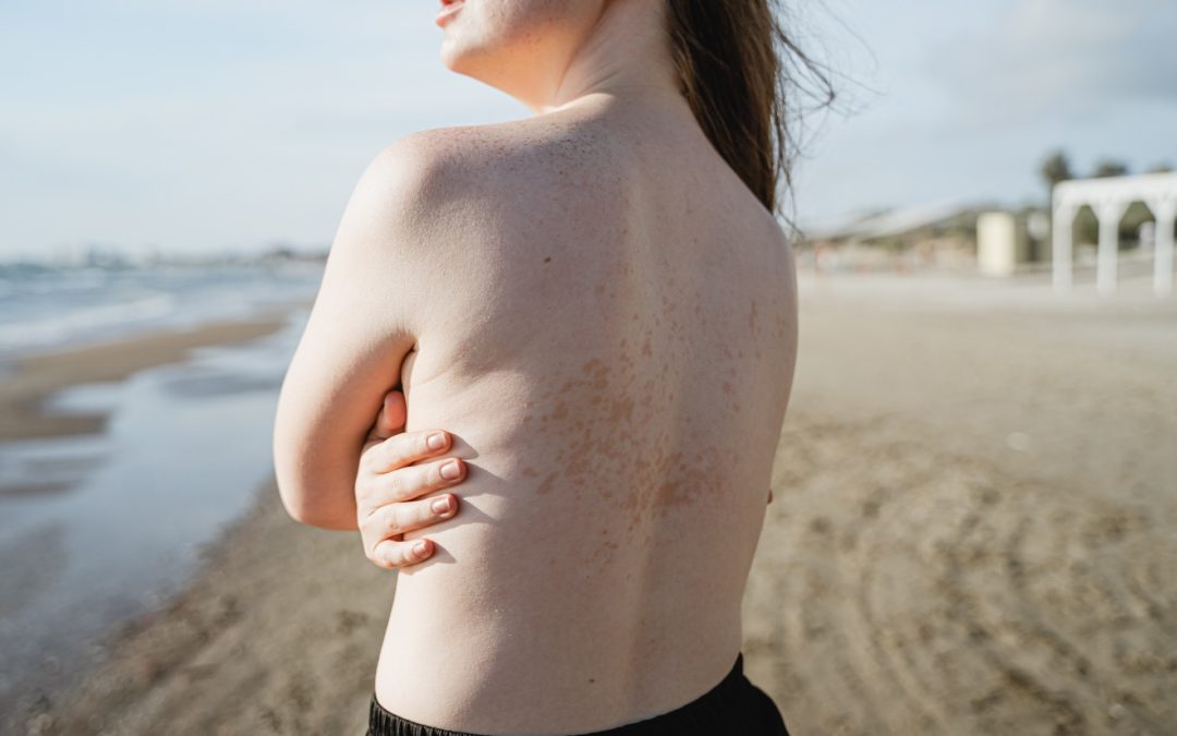 How Will Climate Change Affect Skin Diseases?