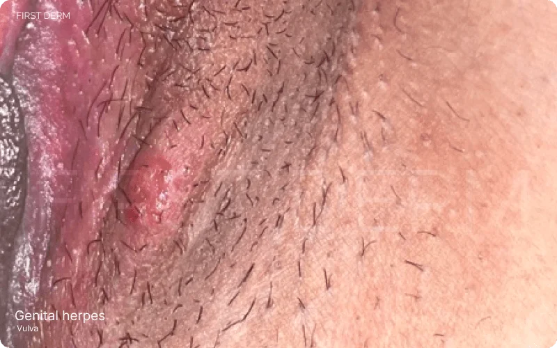 Genital Herpes in Women: Image depicts a reddish blister on the inner lips, a common symptom of a genital herpes outbreak