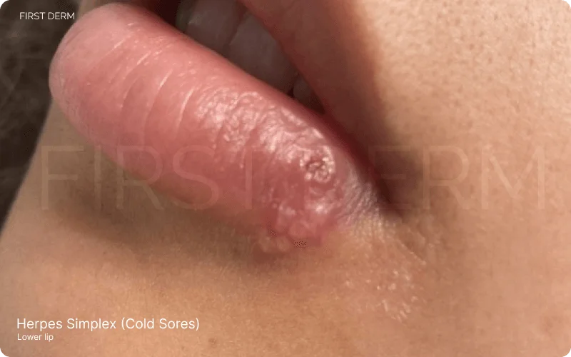 Image depicting Herpes Simplex Labialis (Cold Sores) with a primary blister on the lip, surrounded by a cluster of smaller blisters, showing signs of scabbing and swelling, characteristic of this condition