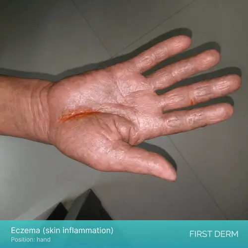 Image of eczema, a form of skin inflammation, on the hand of an individual with dark brown skin tone. The affected area is located along the line of the thenar of the palm and appears red, dry, and scaly. Additionally, there is a reddish patch on one of the fingers near the affected area.