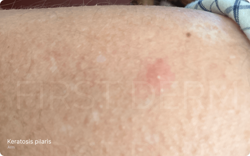Close-up image of the upper arm featuring multiple small, rough, non-itchy raised bumps in either white or red, indicative of Keratosis Pilaris. This benign skin condition is characterized by extra keratin production, leading to a rough texture on the skin. 