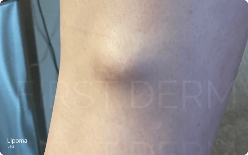 Close-up image of the leg featuring a soft, rounded, non-itchy raised bump under the skin, indicative of a lipoma. This non-cancerous tumor is made up of fat cells and grows slowly in the subcutaneous tissue. 