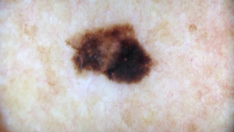 melanom bilder rygg dermatoskopi hudcancer ICD 10 C43.9