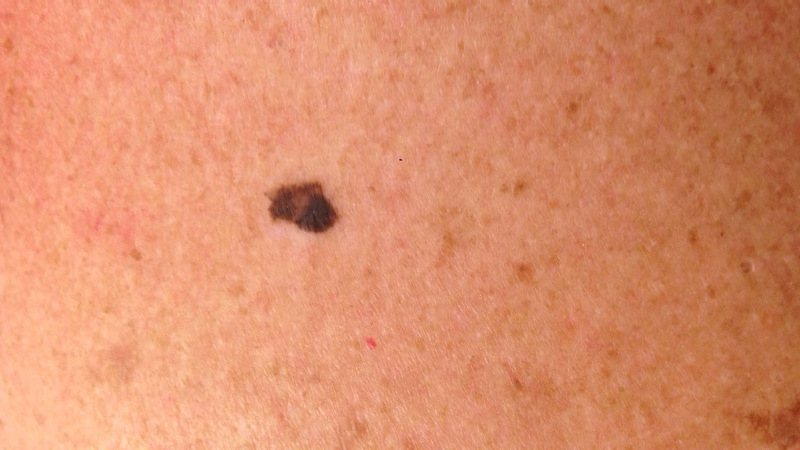 melanoma bilder hög kvalitet hudcancer ICD 10 C43.9