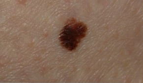 melanoma pictures breast high quality skin cancer ICD 10 C43.9