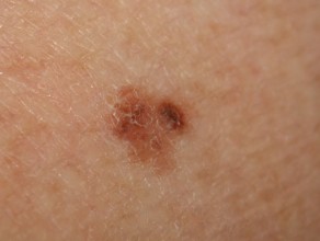 melanoma pictures face high quality skin cancer ICD 10 C43.9