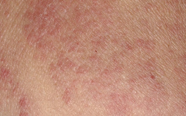 Eczema Can Last Into Adulthood