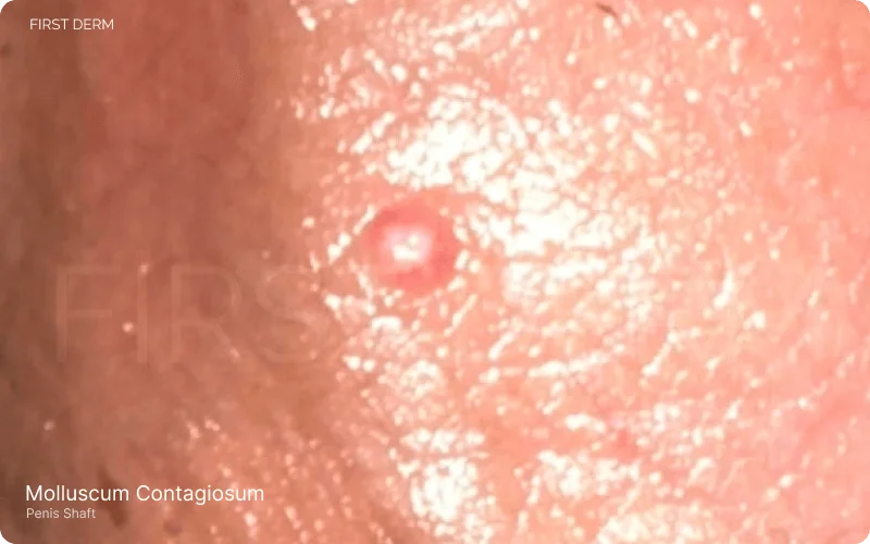 molluscum contagiosum, showing a reddish-whitish pimple on the penis shaft, characterized as a small, painless lesion