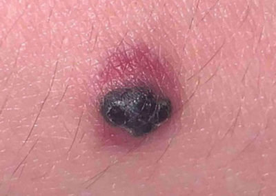 Nodular melanoma (2) skin