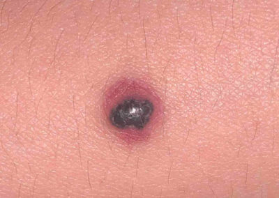 Nodular melanoma (1) skin