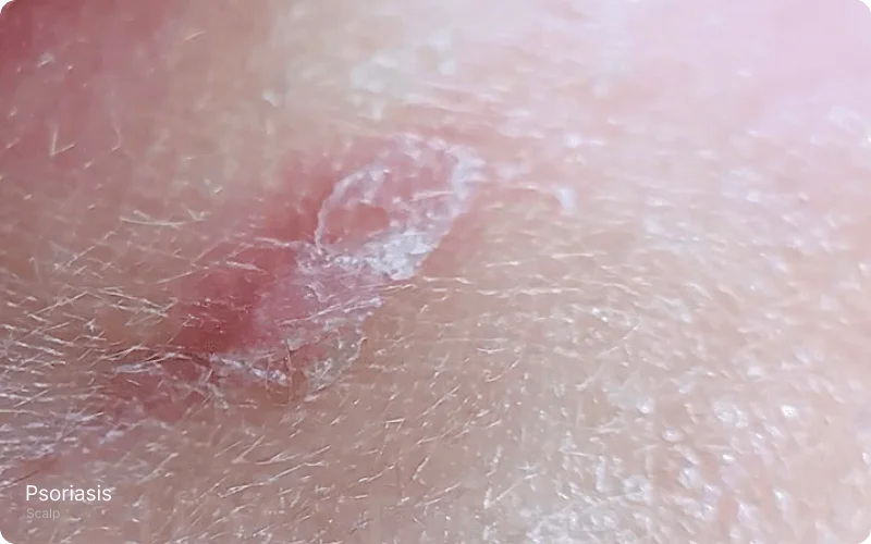 Close-up view of a scalp showing thickened, red, scaly plaques covered with silvery scales, indicative of Psoriasis Vulgaris. The condition is characterized by patches and discolorations without associated itchiness