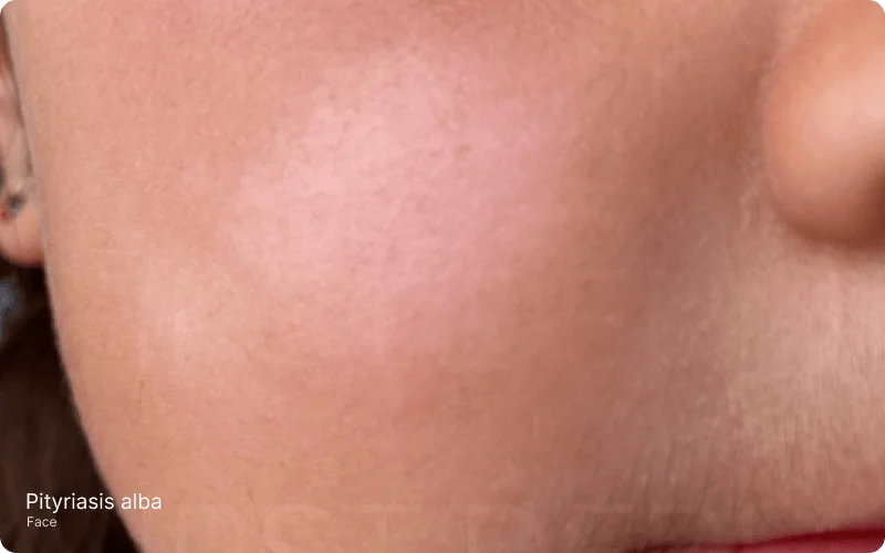 Close-up image of the face showing areas of decreased pigmentation, characteristic of Pityriasis Alba. These patches and discolorations without the itch often occur as a residual condition of mild eczema and may become more visible with sun exposure.