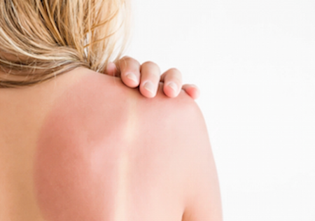 5 Remedies To Ease Sunburns
