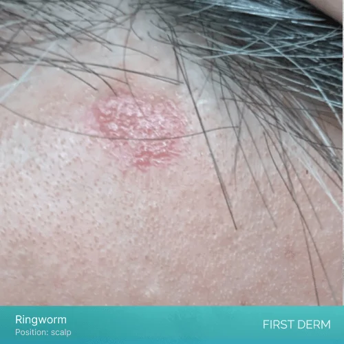 A photo of a person’s scalp with a reddish circular patch of scaly and inflamed skin that is a sign of ringworm, a fungal infection that affects the hair and skin