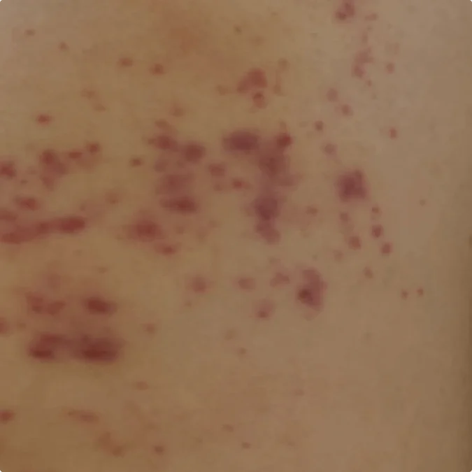 Cercarial Dermatitis (Swimmer’s itch)