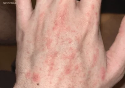 A close-up view of a human hand with small red bumps on the skin, indicating an allergic reaction to parasites in water. This condition is also known as swimmer’s itch or cercarial dermatitis