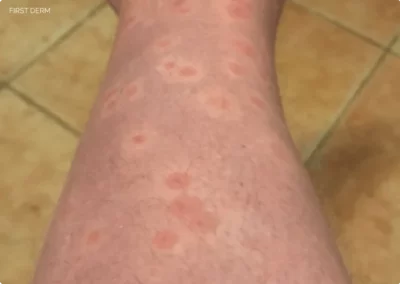 A close-up view of a human leg with pigmented skin that has light brown patches with reddish spots in the center, indicating an allergic reaction to parasites in water. This condition is also known as swimmer’s itch or cercarial dermatitis