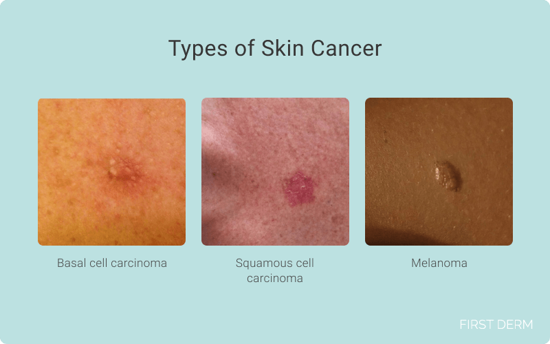images of 3 main types of skin cancer: basal cell carcinoma, squamous cell carcinoma, and melanoma