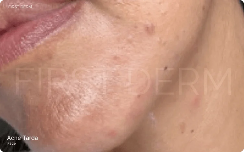 White spots on the face, indicative of Acne Tarda, with a focus on the chin area displaying clogged pores and inflammation